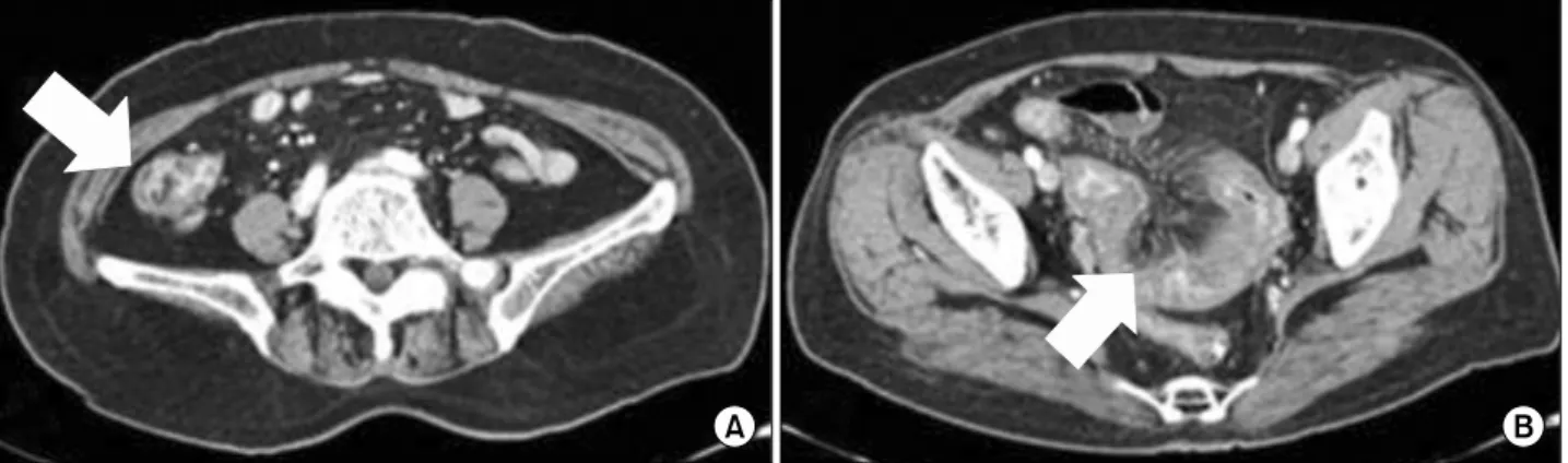 Figure 1. Abdomen  and  pelvis  CT.  (A)  Diffuse  severe  edematous  wall  thickening  in  distal  ileum  and  ileocecal  region  with  luminal  collapse  (arrow)