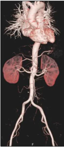 Figure 3. Aorta  CT.  There  was  no  evidence  of  vasculitis  in  aorta  and  its  major  branches.