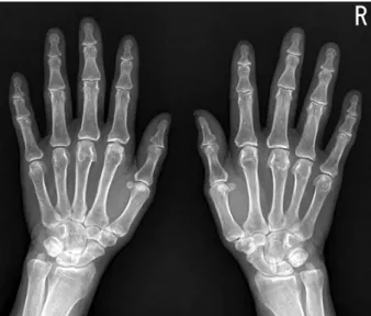 Figure 5. Lateral  radiograph  of  the  skull  shows  numerous  bone  lytic  lesions  which  are  typical  for  the  appearance  of  multiple  myeloma.