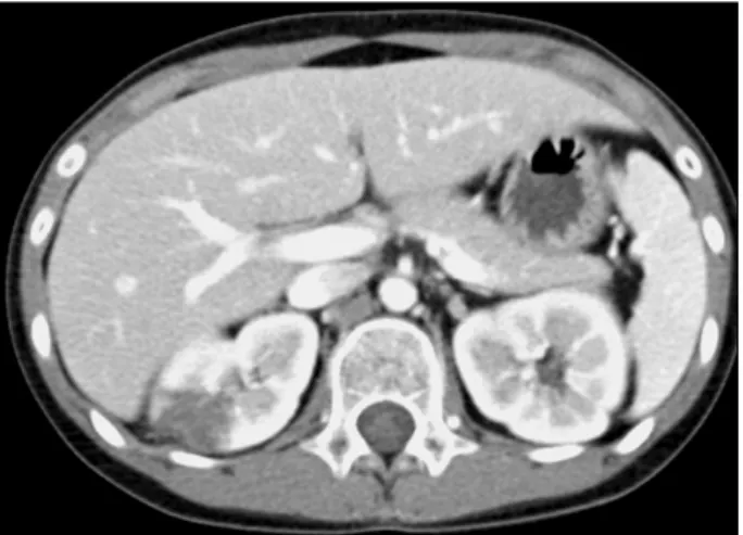 Figure 2. Focal  atrophic  changes  in  the  upper  pole  of  the  right  kidney.