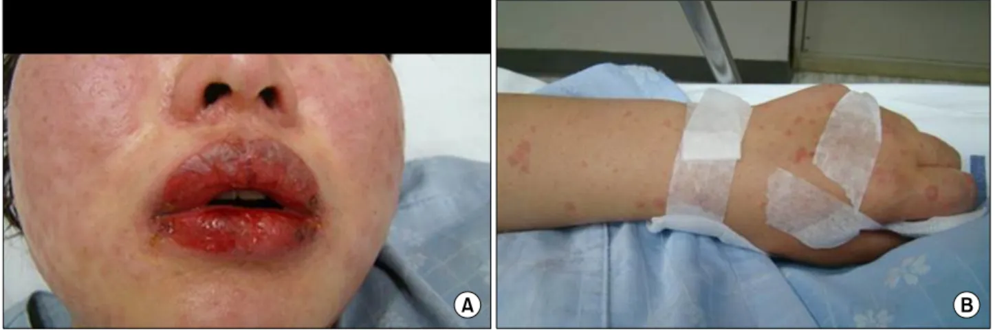 Figure 1.  Day  1,  The  patient  had  diffuse  erythema  of  the  face,  erosion  of  the  lips  and  oral  mucosa,  and  erythematous  macules  and  multiple  clear,  small,  fluid-filled  vesicles  on  her  extremities.