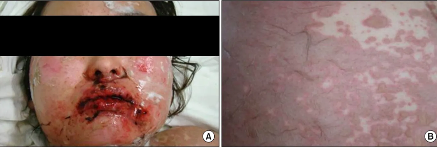 Figure 3.  Day  6,  The  vesicles  and  macules  changed  to  bullae,  and  Nikolsky’s  sign  was  present.