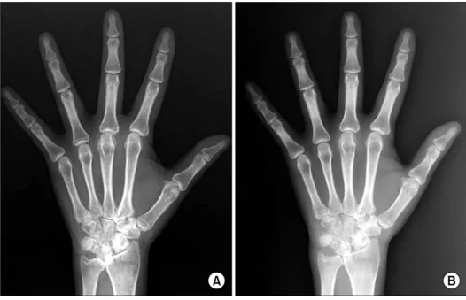 Figure  2.  (A)  Computed  tomography  (CT)  with  enhancement  of  chest  shows  known  tuberculosis-destroyed  lung  with  acute  pneumonic  consolidation
