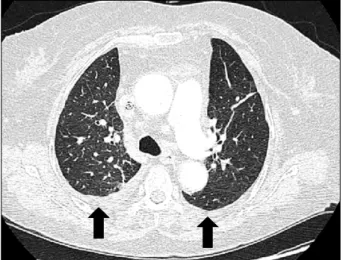 Figure 1. Chest  CT  shows  bilateral  pleural  effusion  (arrows). 