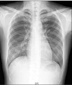 Figure 1. Chest  X-ray  showing  ill-defined  increased  opacity  in  the  right  lower  lung.