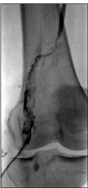 Figure 4. Lower  extremity  venograph  showing  a  thrombus  in  the  left  popliteal  vein  and  the  catheter  used  for  the  peripheral  venous  approach.