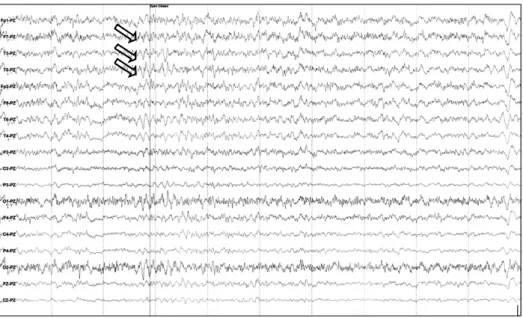 Figure 1. Electroencephalogram  was  characterized  excessive  beta  wave  (arrows)  at  the  anterior  and  temporal  zone