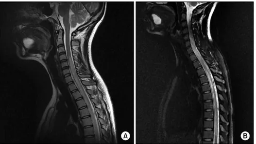 Figure 1. A  28-year-old  woman  diagnosed  with  systemic  lupus   ery-thematosus, presented with recurrent  visual disturbance and sudden onset of  paraplegia