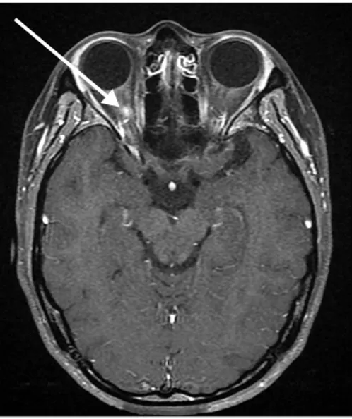 Figure 2. Axial  T1-weighted  contrast  enhanced  fat  suppression  image  of  brain  demonstrates  subtle  enhancement  at  the  right  intraorbital  nerve  (arrow).