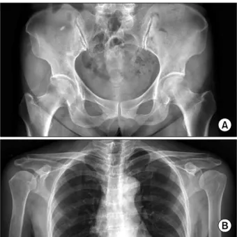 Figure 1. There  are  no  abnormal  findings  on  shoulder  (A)  and  pelvis  x-ray  (B).PMR의 18-FDG-PET소견으로는 윤활낭염,  윤활막염,  연조직 염증 및 혈관염 등 다양한 염증 소견을 보인다 (3)
