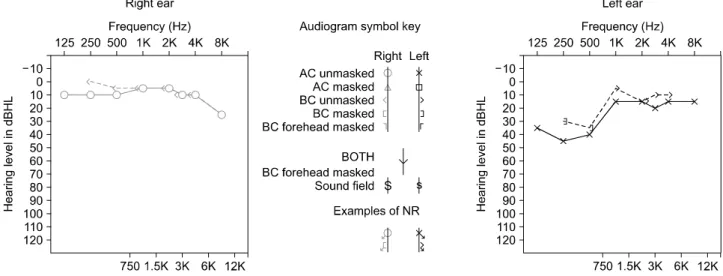 Figure 2. Pure  tone  audiogram  showed  that  the  right  ear  was  normal,  but  the  hearing  threshold  level  of  the  left  ear  was  increased  to  45  dB  HL  in  air  conduction  (AC)  audiometry  and  bone  conduction  (BC)  audiometry