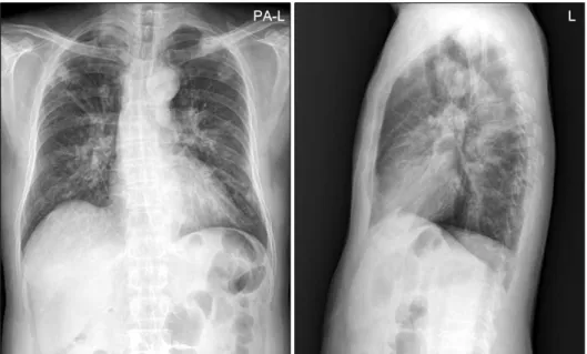 Figure 1. Chest  X  ray  (PA  and  lateral  view)  shows  nodular   opa-cities  and  cavitary  lesions  in  both  upper  lung  fields  and  patchy   opa-cities  in  both  lower  lung  fields.