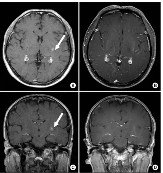 Figure 5. T1-enhanced  MR  images  before  (A,  C)  and  after  (B,  D)  four  times  cyclophosphamide  pulse   the-rapy