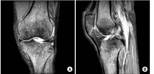 Figure 1. Coronal  (A)  and  sagittal  (B)  proton  density  fat-suppressed  images  of  the  left  knee  showing  heterogenous  increased  signal   inten-sity  in  the  patella,  bilateral  femoral  and  tibial  condyles.