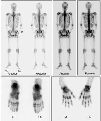Figure 1. Bone  scan:  increased  radioisotope  uptake  in  bilateral  shoulders,  and  left  knee.