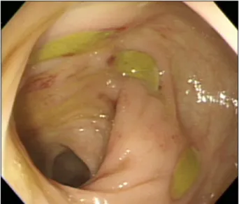Figure 1. Initial  colonoscopy  showed  well  demarcated  multiple  ulcers  at  descending  colon.