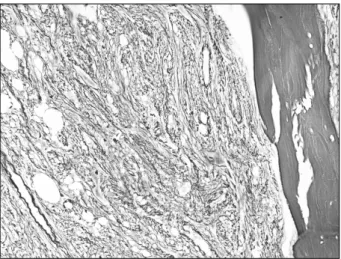 Figure 3. Reticulin  staining  of  the  bone  marrow  showing  marked  diffuse  reticulin  fibrosis  (reticulin  stain,  ×200).