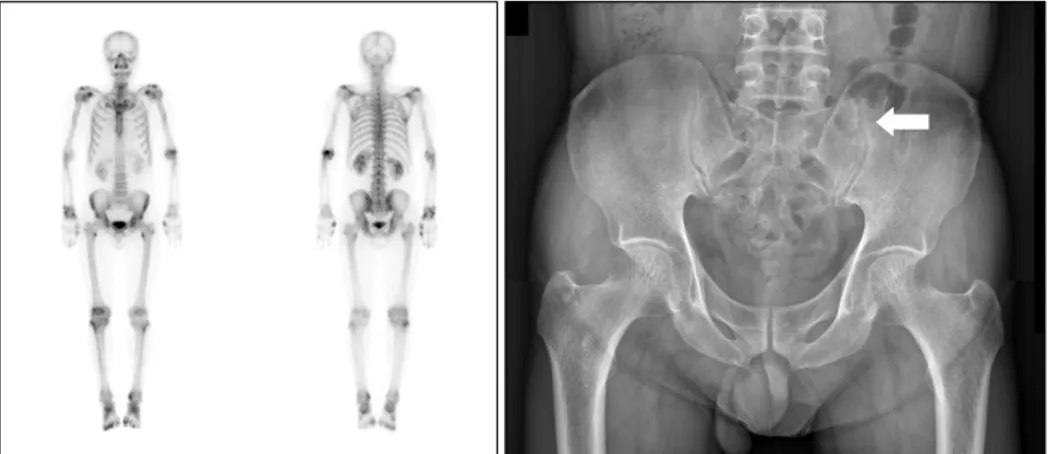 Figure 1. Bone  scan  shows  multi- multi-ple  enthesopathy  at  the  site  of  the  left  elbow,  the  lesser  trochanters  of  both  femurs,  the  right  knee,  and  both  ankles