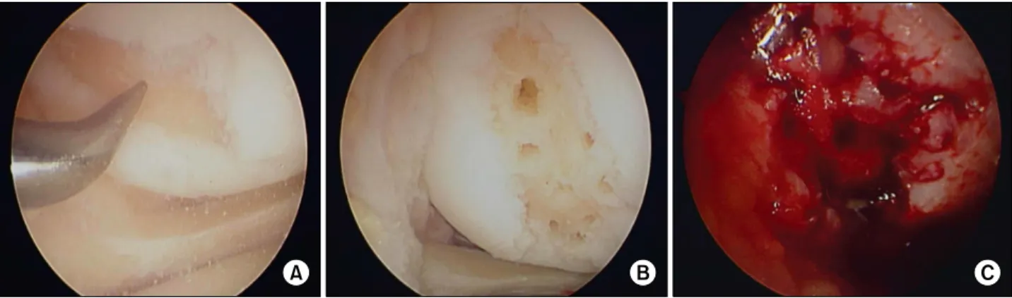Figure 1. (A)  Microfracture  using  metal  awl.  (B)  Arthroscopic  finding  of  microfracture