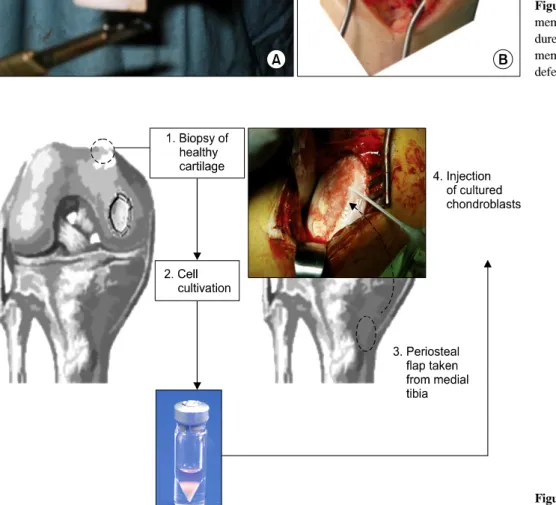 Figure 3. ACI:  autologous  cho- cho-ndrocyte  implantation.약한 섬유연골이라 할지라도 좋은 단기임상결과,  경제적 측면,  술기적 측면 등을 고려한다면,  미세골절술은 그 나름의 장점을 지녀 앞으로도 오랫동안 사용될 수 있는 술기이다
