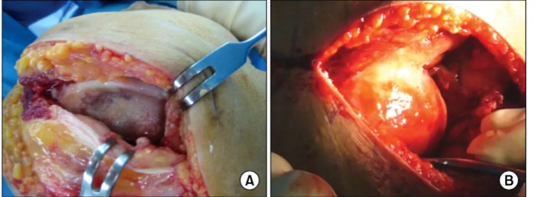 Figure 4. (A)  Severe  arthritic  findings.  (B)  Operation  findings  after  gel  type  ACI.