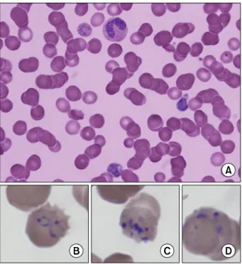 Figure 1. Peripheral  blood  smear  findings  show  many  trophozoites,  schizonts  and  ring  forms  (×1,000)  (A)