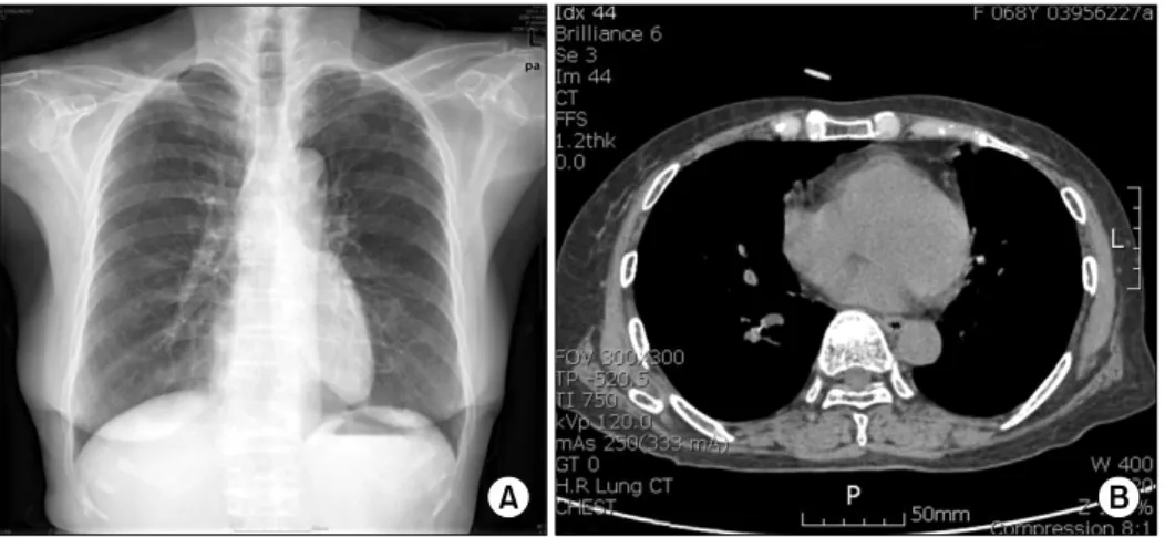 Figure 1. Chest  images  (A)  Chest  x-ray  is  normal  without  nodule  or  infiltration,  (B)  Chest  CT  shows  normal  lung  and  mediastinal  structures