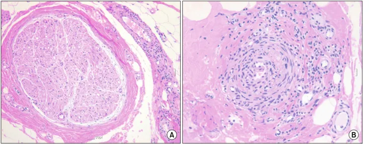 Figure 3. Pathologic  findings.  (A)  Moderate  mononuclear  inflammatory  cell  infiltrates  are  noted  in  small  sized  epinurial  vessels  (H&amp;E, 