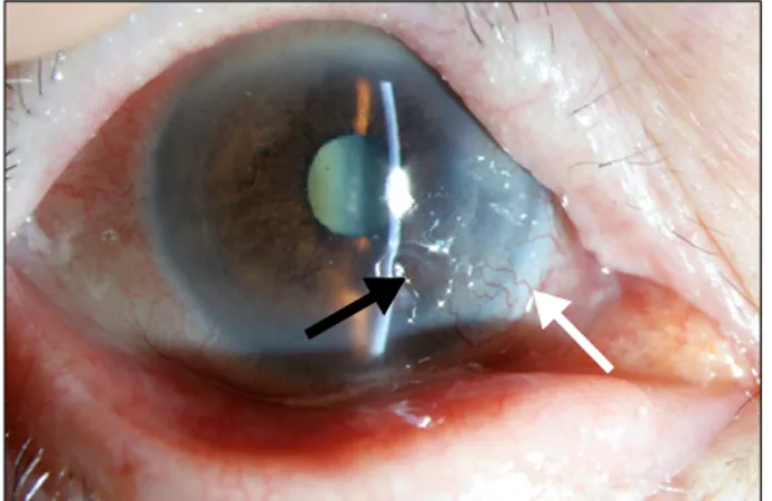 Figure 1. Slit  lamp  examination  of  the  right  eye  shows  a  peripheral  corneal  ulcer  (black  arrow)  and  adjacent  corneal  neovascularization  (white  arrow).