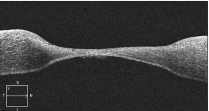 Figure 3. Optical  coherence  tomography  exam  reveals  corneal  thinning  in  the  right  eye.