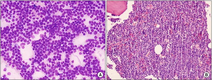 Figure 2. Bone  marrow  aspiration  (A)  and  biopsy  (B)  show  that  bone  marrow  space  is  packed  with  increased  blasts