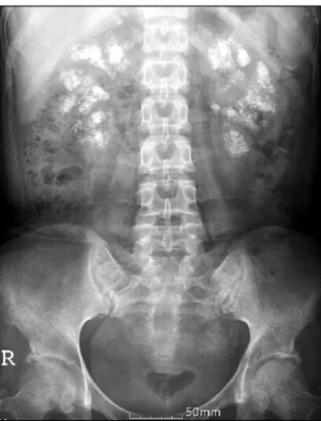 Figure 1. Kidney-ureter-bladder  (KUB)  radiograph  demonstrating  multiple  calculi  in  both  kidney.