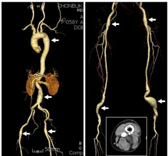 Figure  1. Multiple  arterial  aneurysmal  dilatations  on  computed  tomography  angiogram
