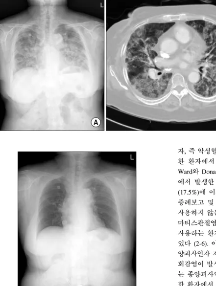 Figure 2. Chest  X-ray  (A)  and  CT  (B)  on  the  forth  hospital  day  showed  diffuse  bilateral  infiltration  that  progressed  over  the  next  3  days.