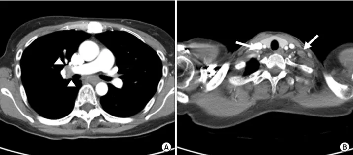Figure 4. Supraclavicular  lymph  node  biopsy  showing  evenly  distributed  small  noncaseating  granulomas  (arrow)    (A)  (H&amp;E  stain, 