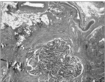 Figure 4. Pathology  specimen  of  thyroid  showed  capsular  inva- inva-sion  of  a  papillary  type  adenocarcinoma  (H  &amp;  E  stain,  ×100).