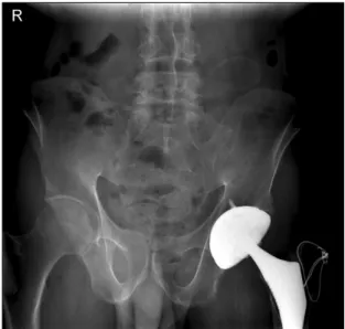 Figure 2. Whole  body  bone  scan.  Increased  uptake  lesions  can  be  seen  in  the  both  elbows,  wrists,  knees  and  ankles.