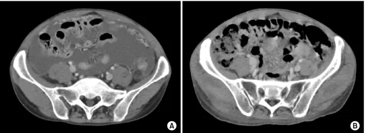 Figure 3. Contrast-enhanced  abdominal  computed  tomography.  (A)  Massive  ascites,  diffuse  omental  infiltration  and  multifocal  peritoneal  thickening  with  enhancement,  suggesting  peritoneal  tuberculosis  in  the  abdomen  CT