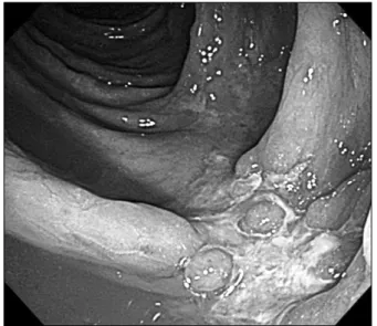 Figure 3. Colonoscopic  findings  show  diffuse  wall  thickening  and  multiple  polypoid  erythematous  elevations  with  aphthous  ulcerations  at  terminal  ileum.다