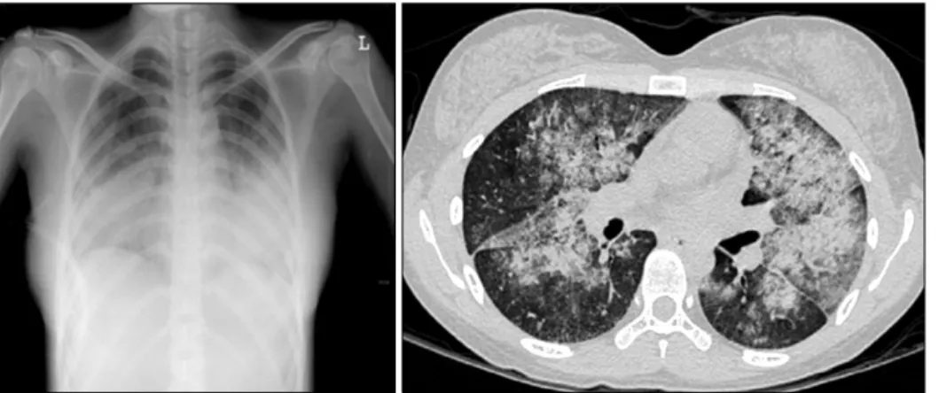 Figure 1. Chest  X-ray  and  chest  computer  tomography  show   diffu-se  patch  ground  glass  opacity  in  both  lung  fields.