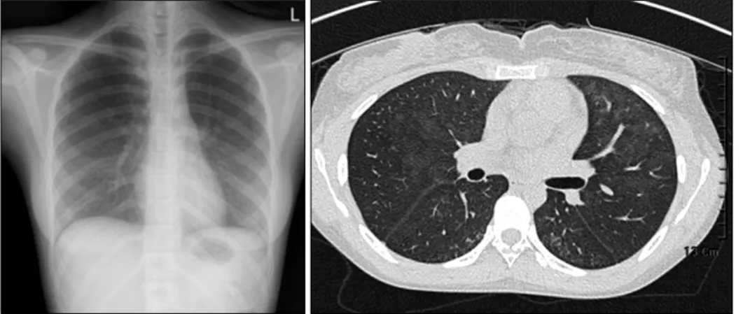 Figure  2. Follow  up  chest  X-ray  and  chest  computer  tomography  show  resolved  bilateral  diffuse   in-filtration  in  both  lower  lung  fields  after  oseltamivir  treatment