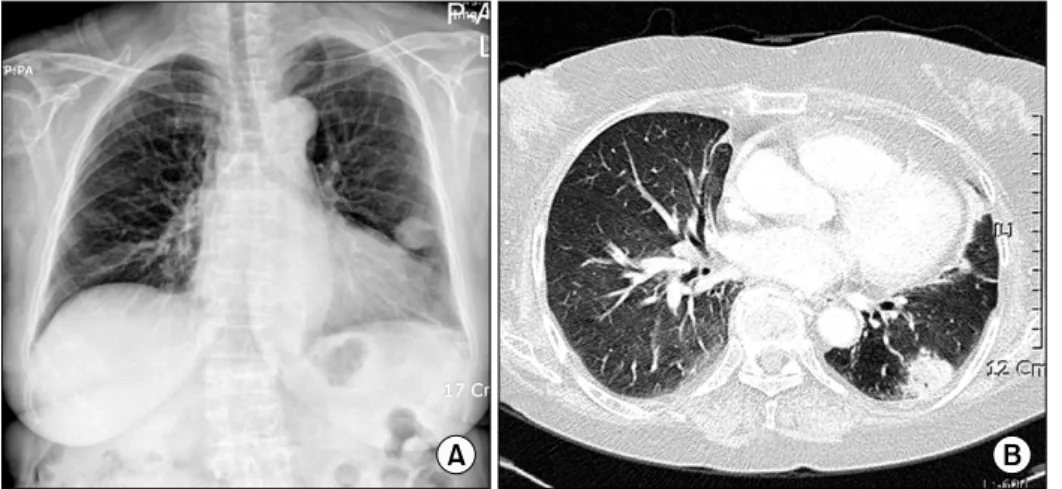 Figure 2. On  admission,  chest  X-  ray  shows  nodular  shadow  on  the  left  lower  lung  field  (A)