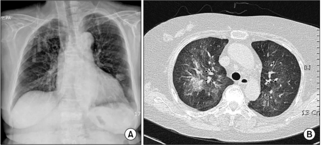 Figure 4. On  the  12th  day  of  ad- ad-mission,  chest  X-ray  shows  bilateral  massive  infiltrates  (A)