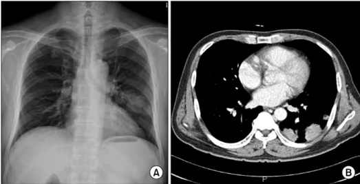 Figure 1. (A)  Nodular  opacity  was  noted  in  left  lower  lung  at  the  time  of  admission