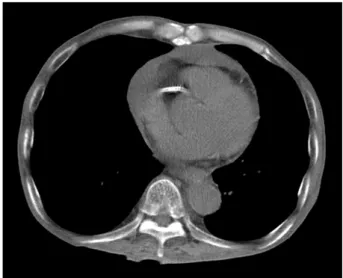 Figure 1. Chest  CT  shows  bilateral  pleural  effusion  and  pericar-