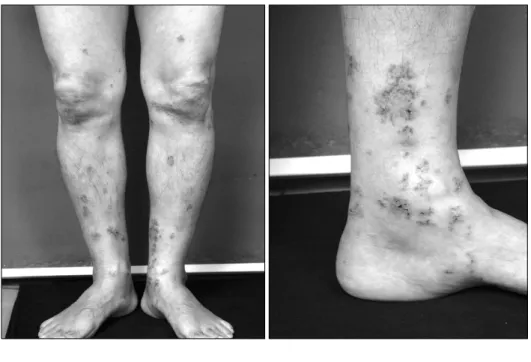 Figure 1. Multiple  rice  sized  ery- ery-themas  and  purpuric  papules  were  seen  on  the  both  lower  extremities.