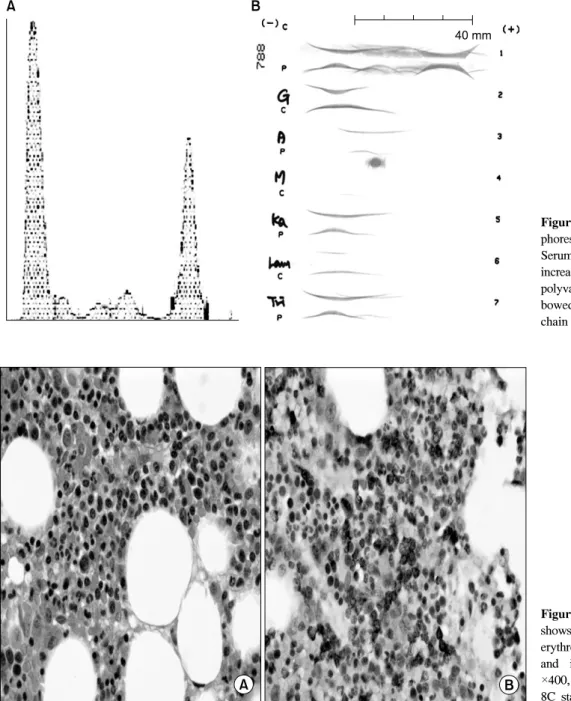 Figure 3. (A)  A  protein  electro- electro-phoresis  shows  an  M-spike.  (B)  Serum  IEP  pattern  shows  moderate  increase  of  gamma  globulin  area  in  polyvalent  antiserum,  and  abnormal  bowed  arcs  in  IgG,  kappa  light  chain  monovalent  an