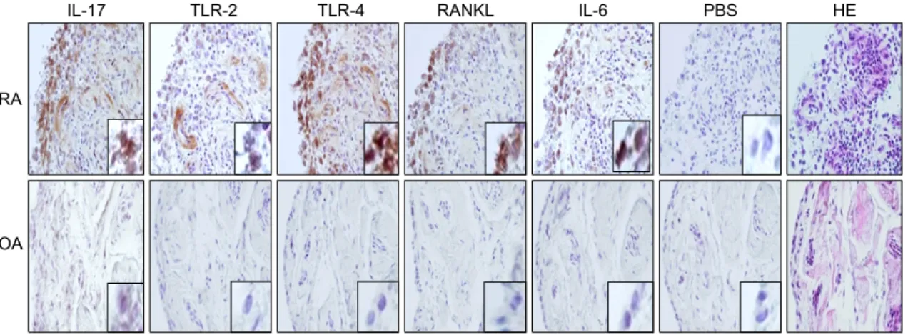 Fig. 4. The  expressions  of  IL-17,  TLR-2,  TLR-4,  RANKL  and  IL-6  was  significantly  greater  in  the  RA  synovium  than  those  in  the  OA  synovium