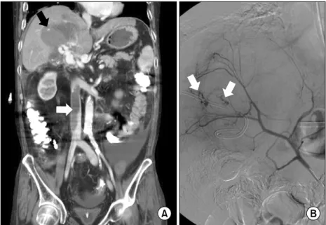 Fig. 1. The  radiographic  evidence  shows  cystic  artery  bleeding  (A)  An  abdominal  computed  tomography  scan  demonstrates  hematomas  (black  arrow)  in  the  gallbladder  and  the  adjacent  hepatic  parenchyma,  and  segmental  venous  thrombus 