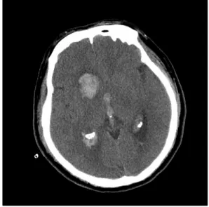 Fig. 2. Brain  computed  tomography  scan  showed  acute  intracerebral  hemorrhage  in  the  right  frontal  lobe,  extending  into  the  ventricles.